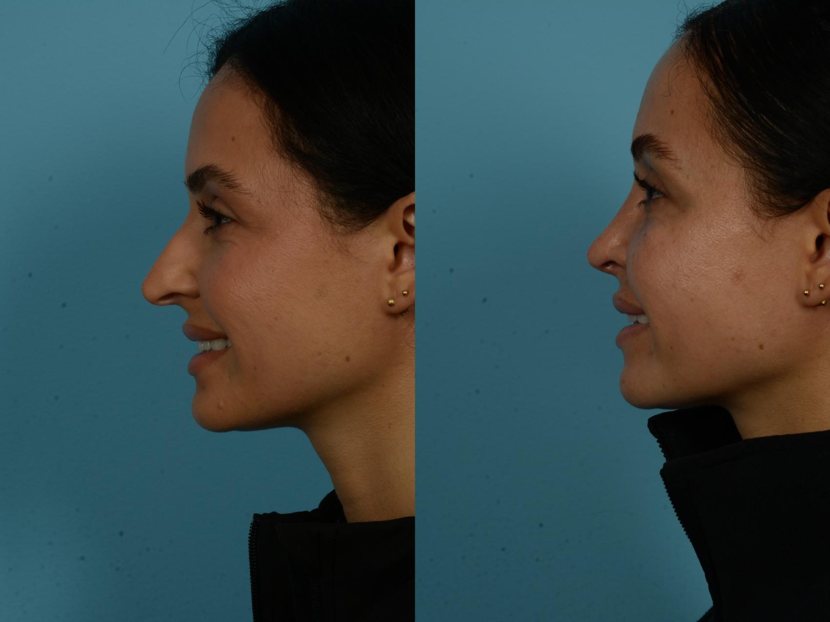 Before & After Rhinoplasty by Dr. Sinno Case 1126 Left Side View in Chicago, IL