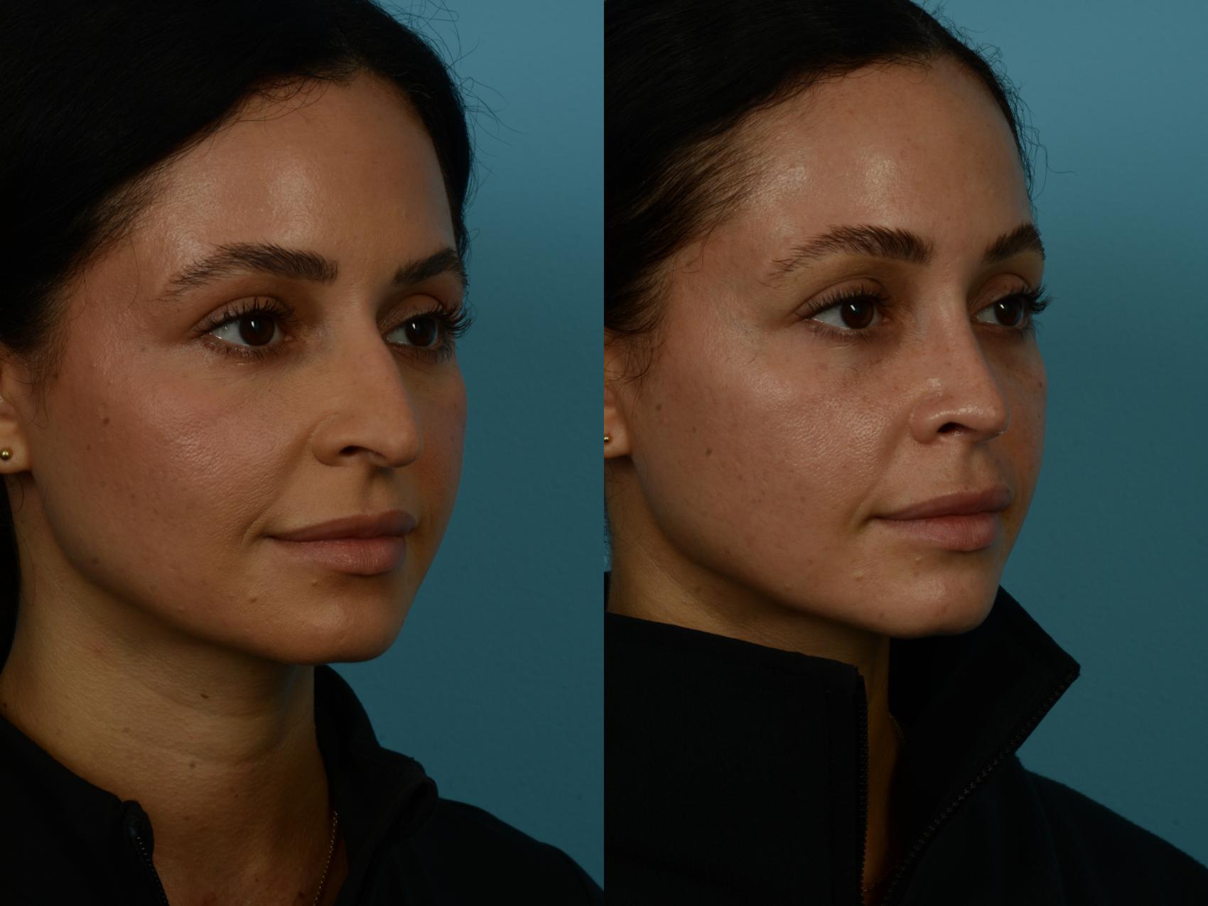 Before & After Rhinoplasty by Dr. Sinno Case 1126 Right Oblique View in Chicago, IL