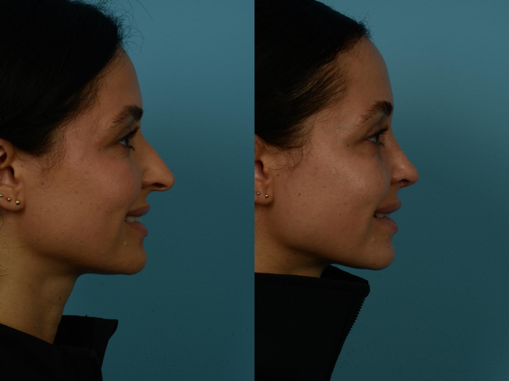 Before & After Rhinoplasty by Dr. Sinno Case 1126 Right Side View in Chicago, IL