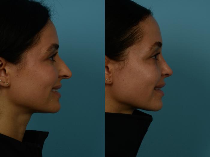 Before & After Rhinoplasty by Dr. Sinno Case 1126 Right Side View in Chicago, IL