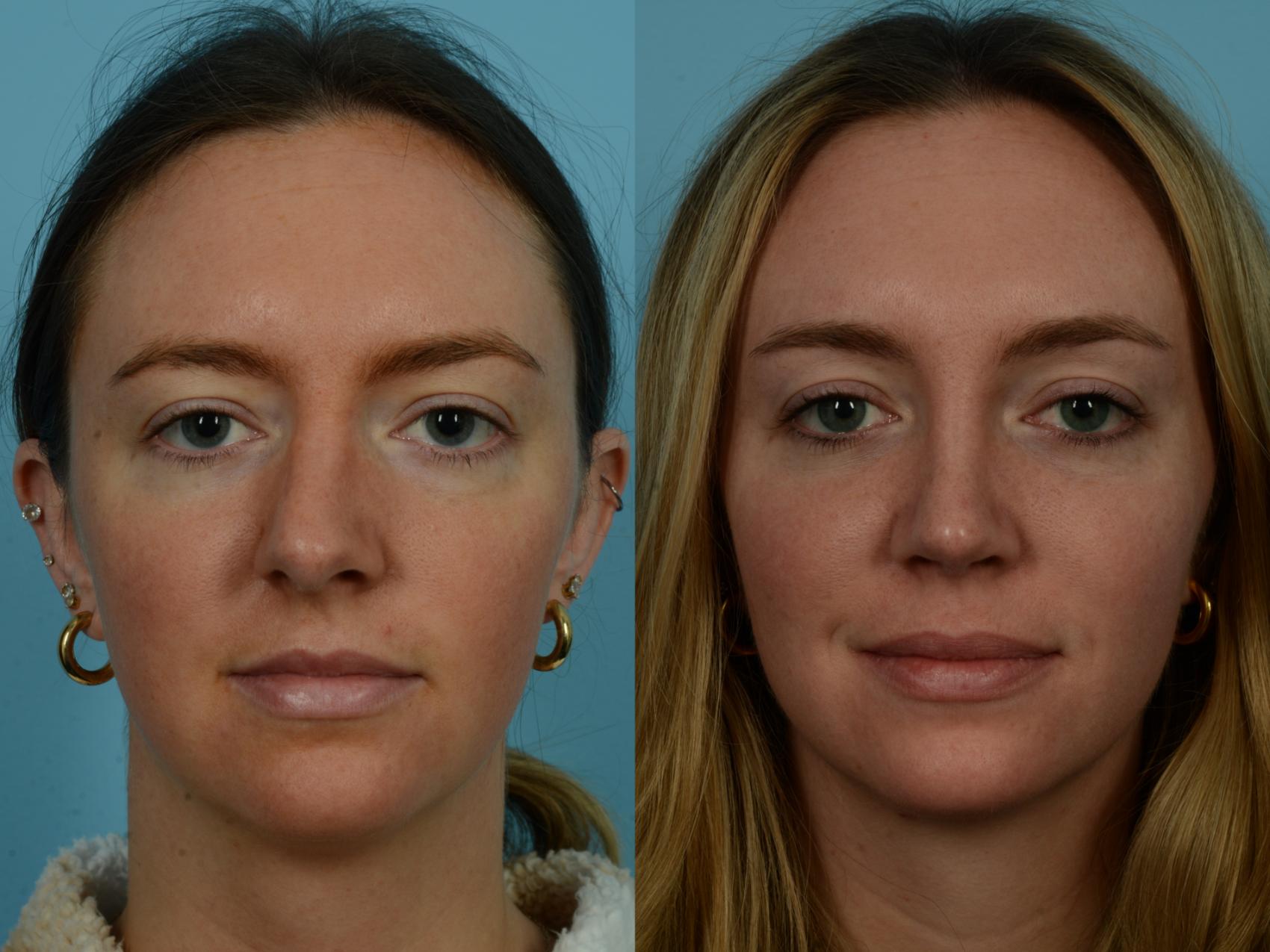 Before & After Rhinoplasty by Dr. Sinno Case 1128 Front View in Chicago, IL