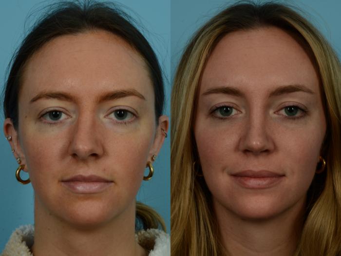 Before & After Rhinoplasty by Dr. Sinno Case 1128 Front View in Chicago, IL