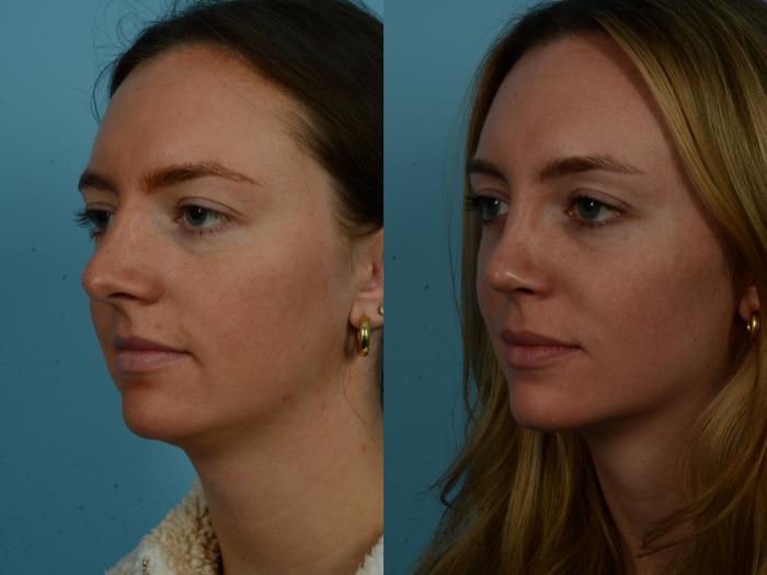 Before & After Rhinoplasty by Dr. Sinno Case 1128 Left Oblique View in Chicago, IL