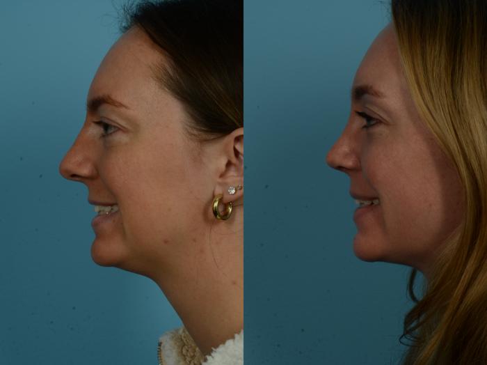 Before & After Rhinoplasty by Dr. Sinno Case 1128 Left Side View in Chicago, IL