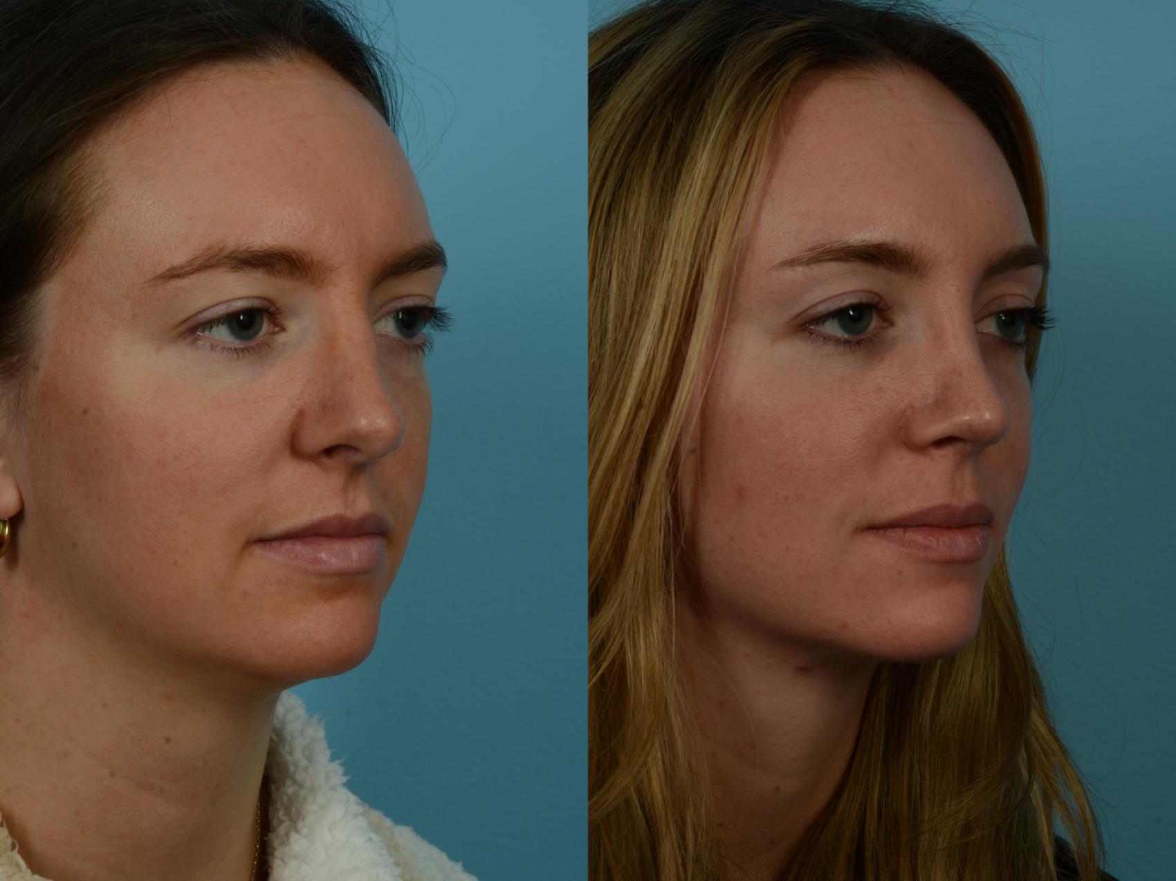 Before & After Rhinoplasty by Dr. Sinno Case 1128 Right Oblique View in Chicago, IL