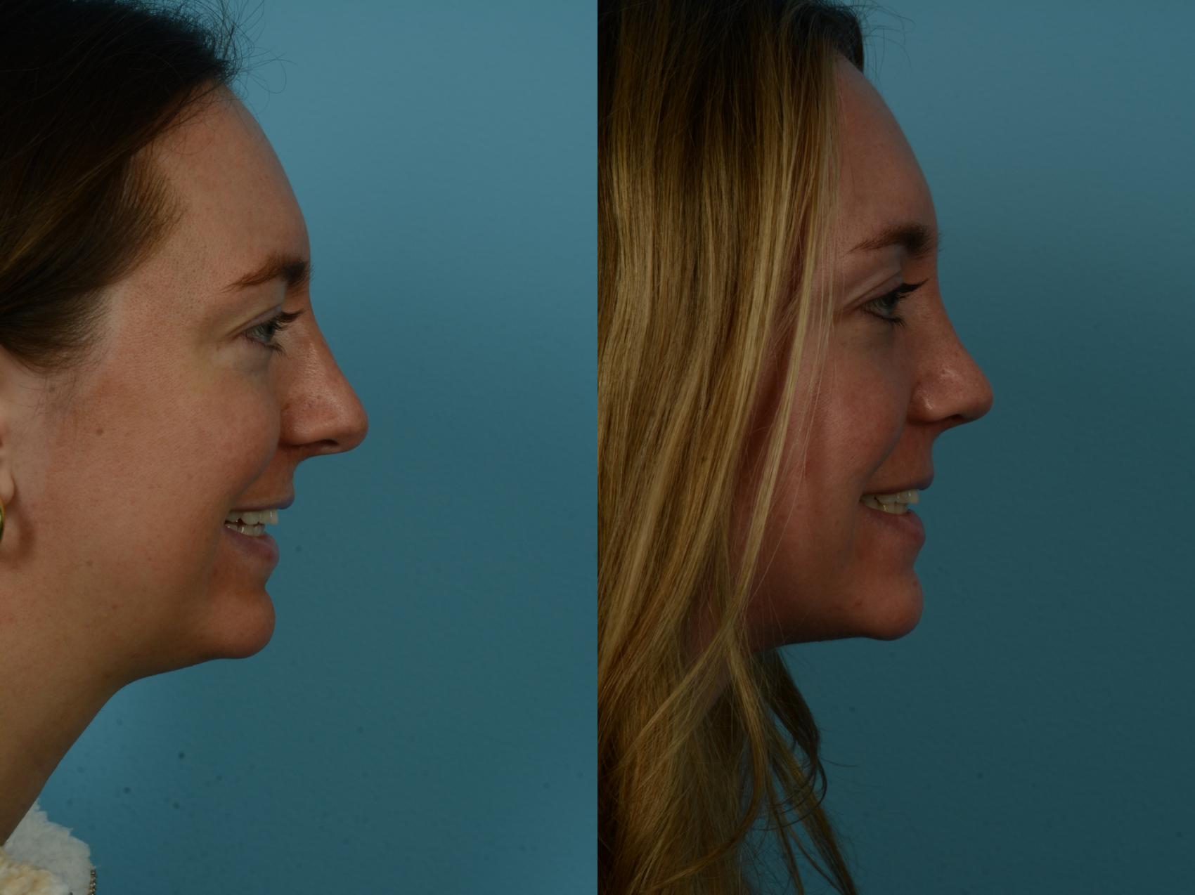Before & After Rhinoplasty by Dr. Sinno Case 1128 Right Side View in Chicago, IL
