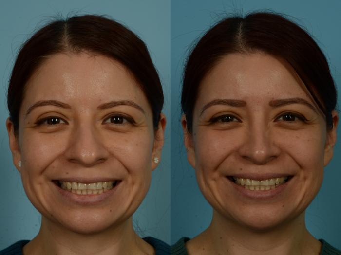 Before & After Rhinoplasty by Dr. Sinno Case 1131 Front View in Chicago, IL