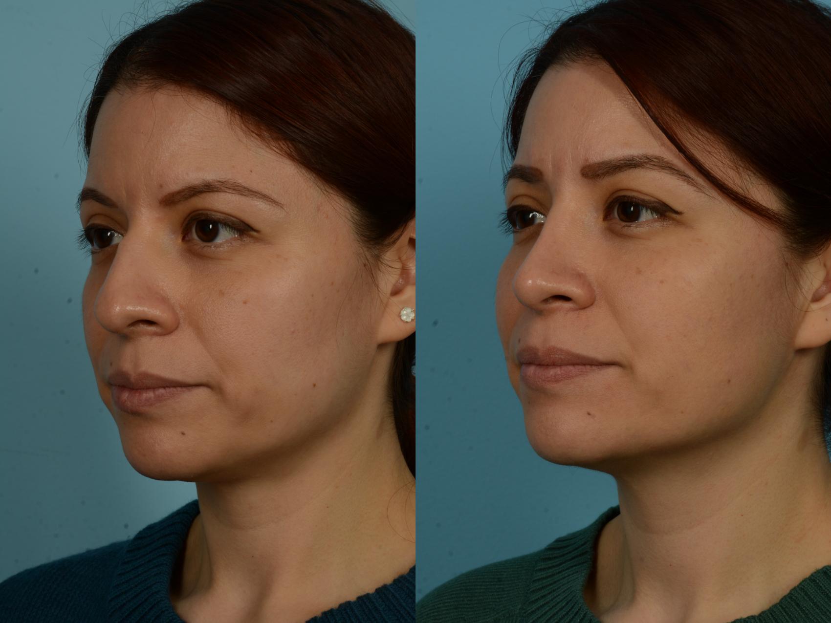 Before & After Rhinoplasty by Dr. Sinno Case 1131 Left Oblique View in Chicago, IL