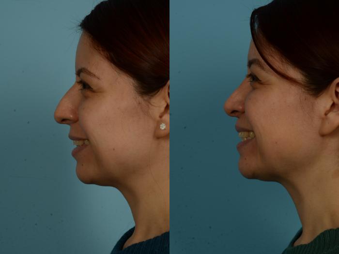 Before & After Rhinoplasty by Dr. Sinno Case 1131 Left Side View in Chicago, IL