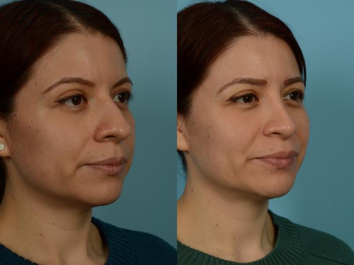 Before & After Rhinoplasty by Dr. Sinno Case 1131 Right Oblique View in Chicago, IL