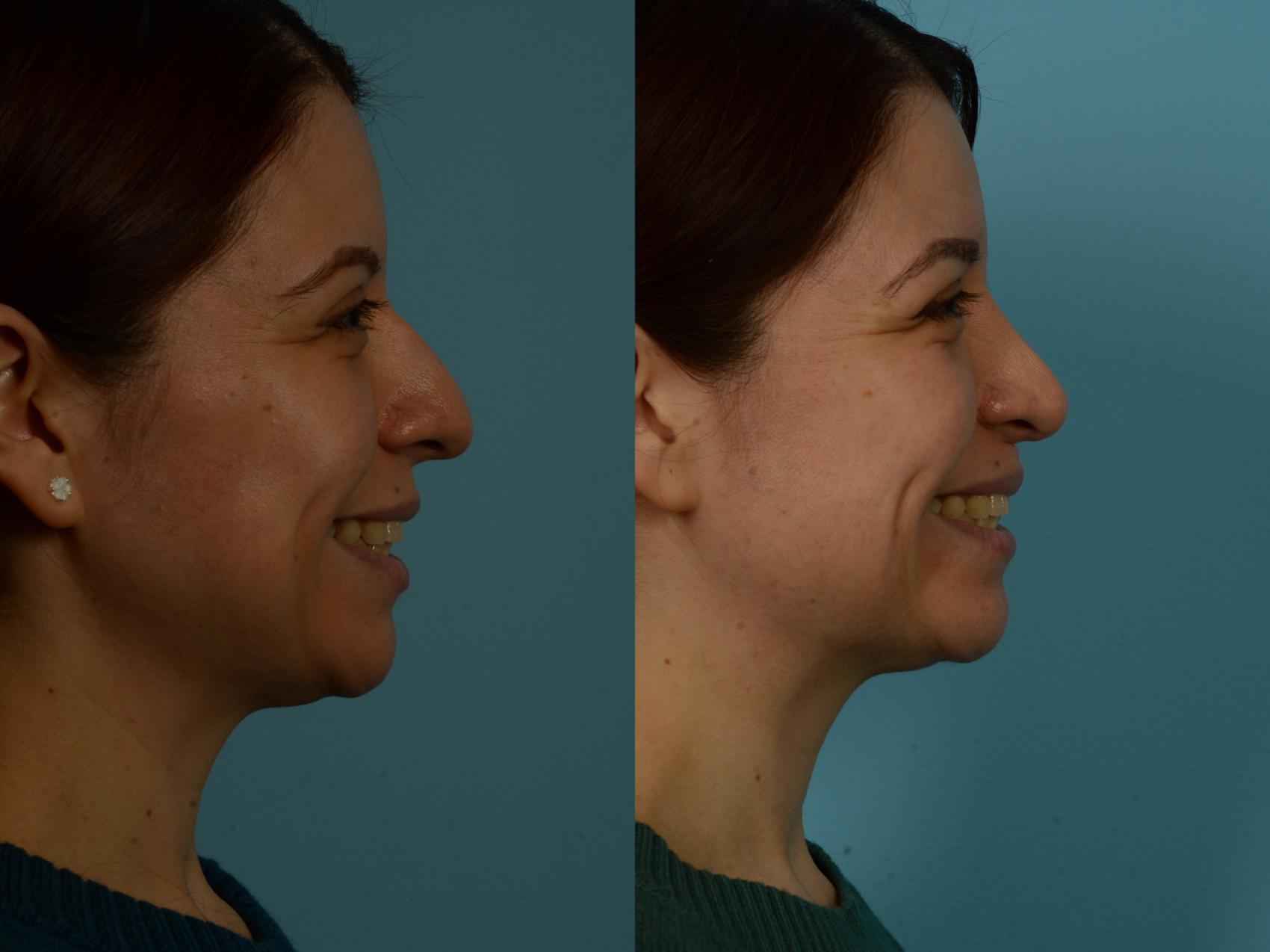 Before & After Rhinoplasty by Dr. Sinno Case 1131 Right Side View in Chicago, IL
