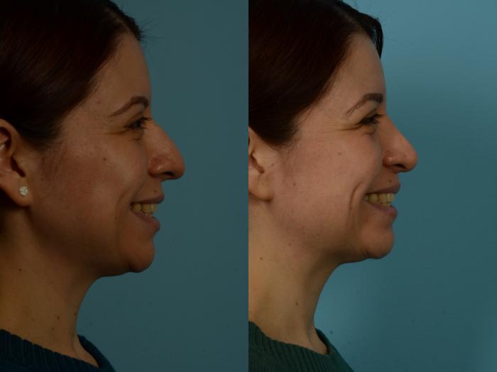 Before & After Rhinoplasty by Dr. Sinno Case 1131 Right Side View in Chicago, IL