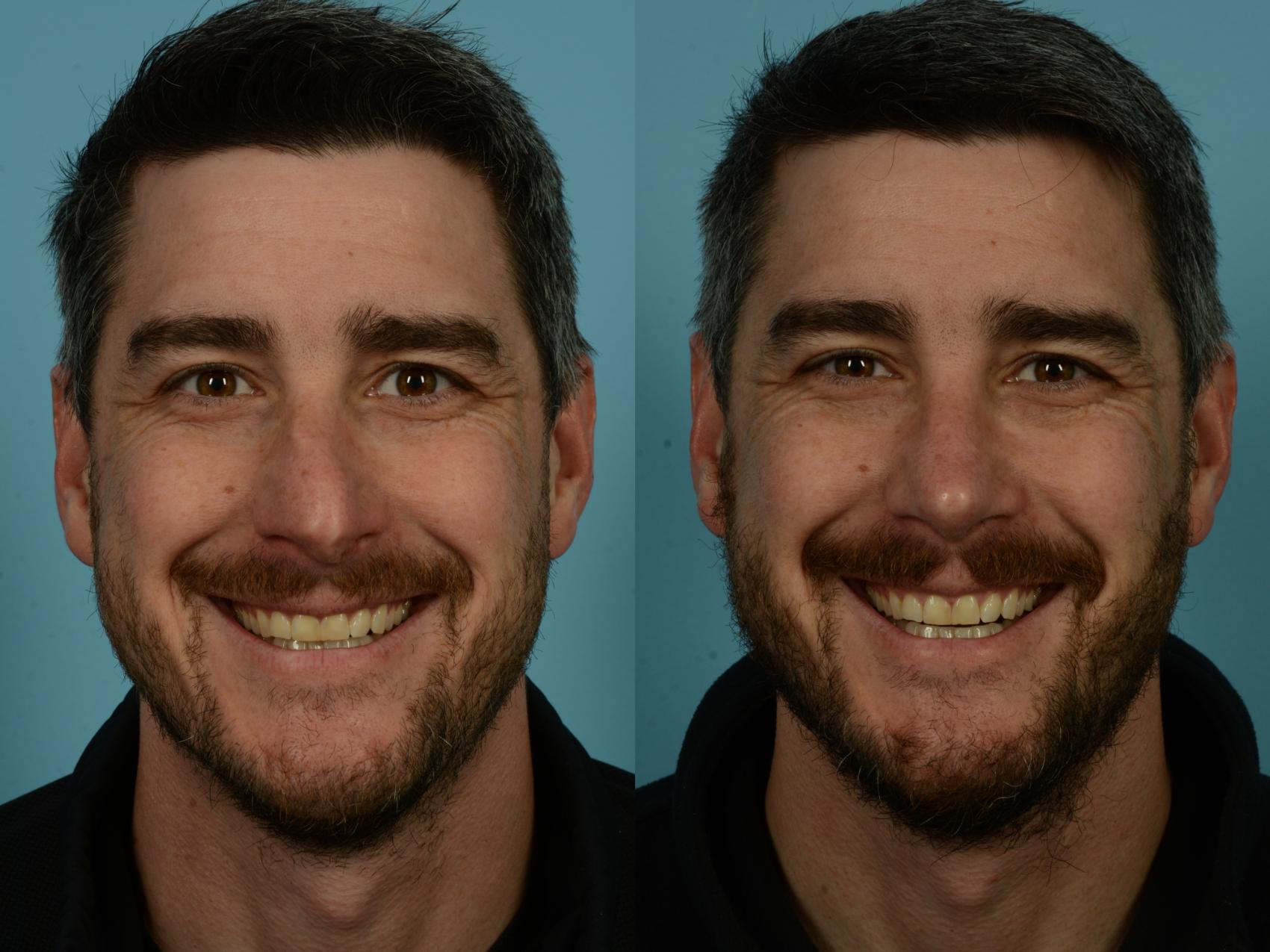 Before & After Rhinoplasty by Dr. Sinno Case 1133 Front View in Chicago, IL