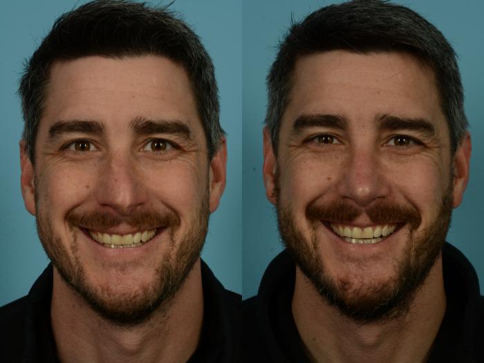 Before & After Rhinoplasty by Dr. Sinno Case 1133 Front View in Chicago, IL
