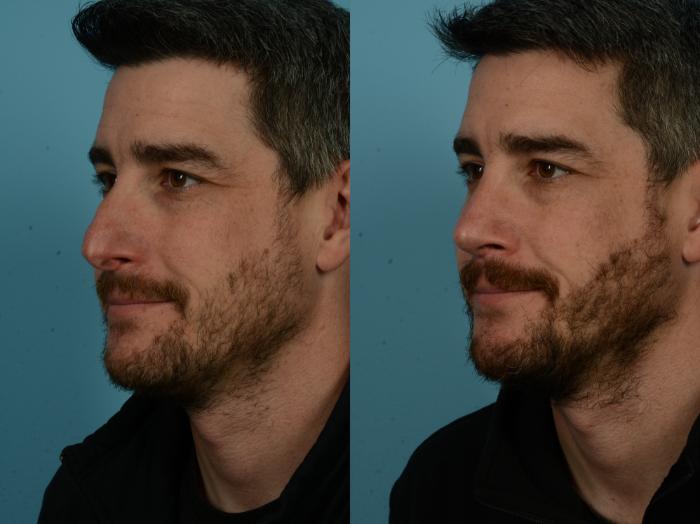 Before & After Rhinoplasty by Dr. Sinno Case 1133 Left Oblique View in Chicago, IL