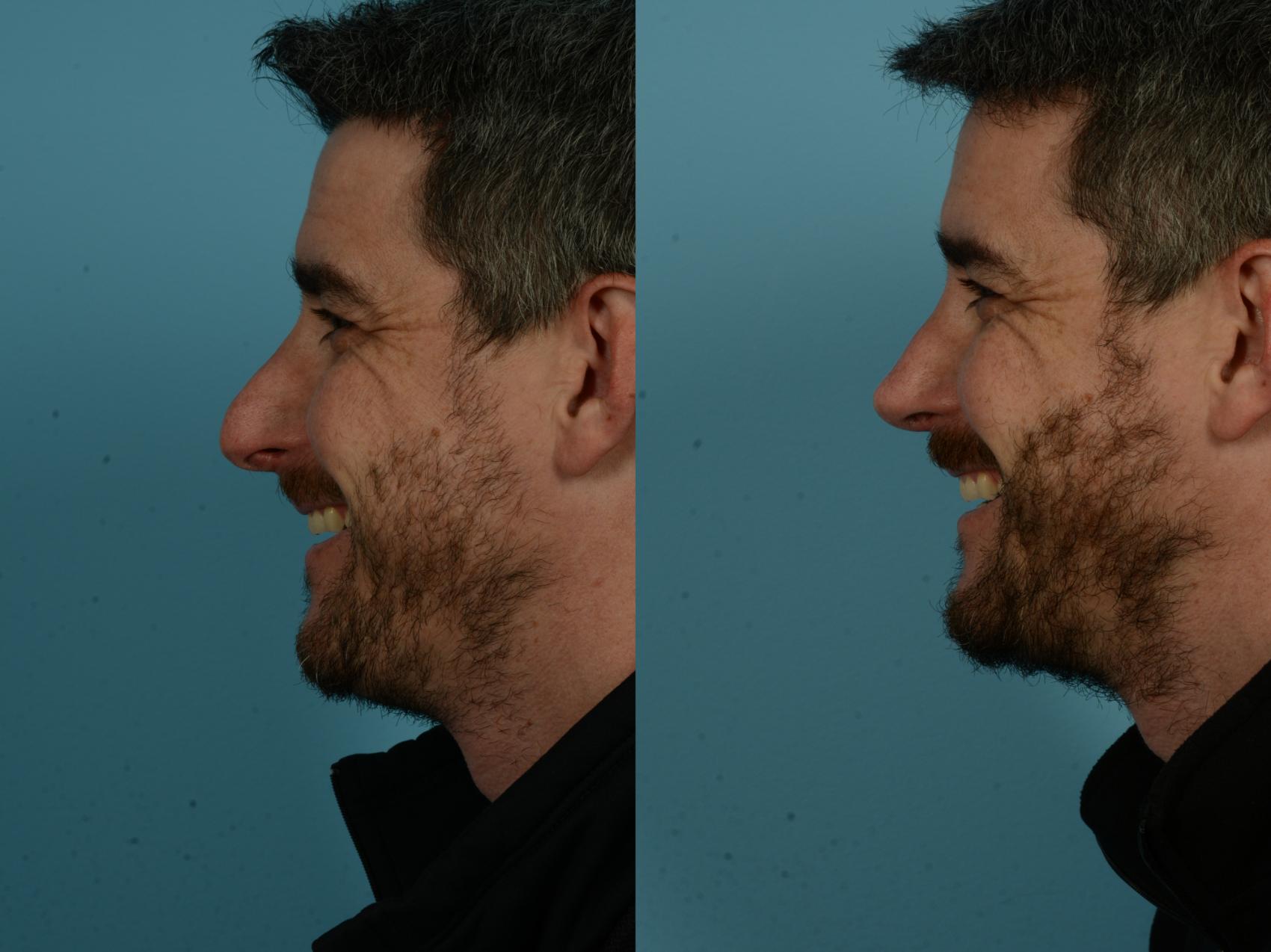 Before & After Rhinoplasty by Dr. Sinno Case 1133 Left Side View in Chicago, IL