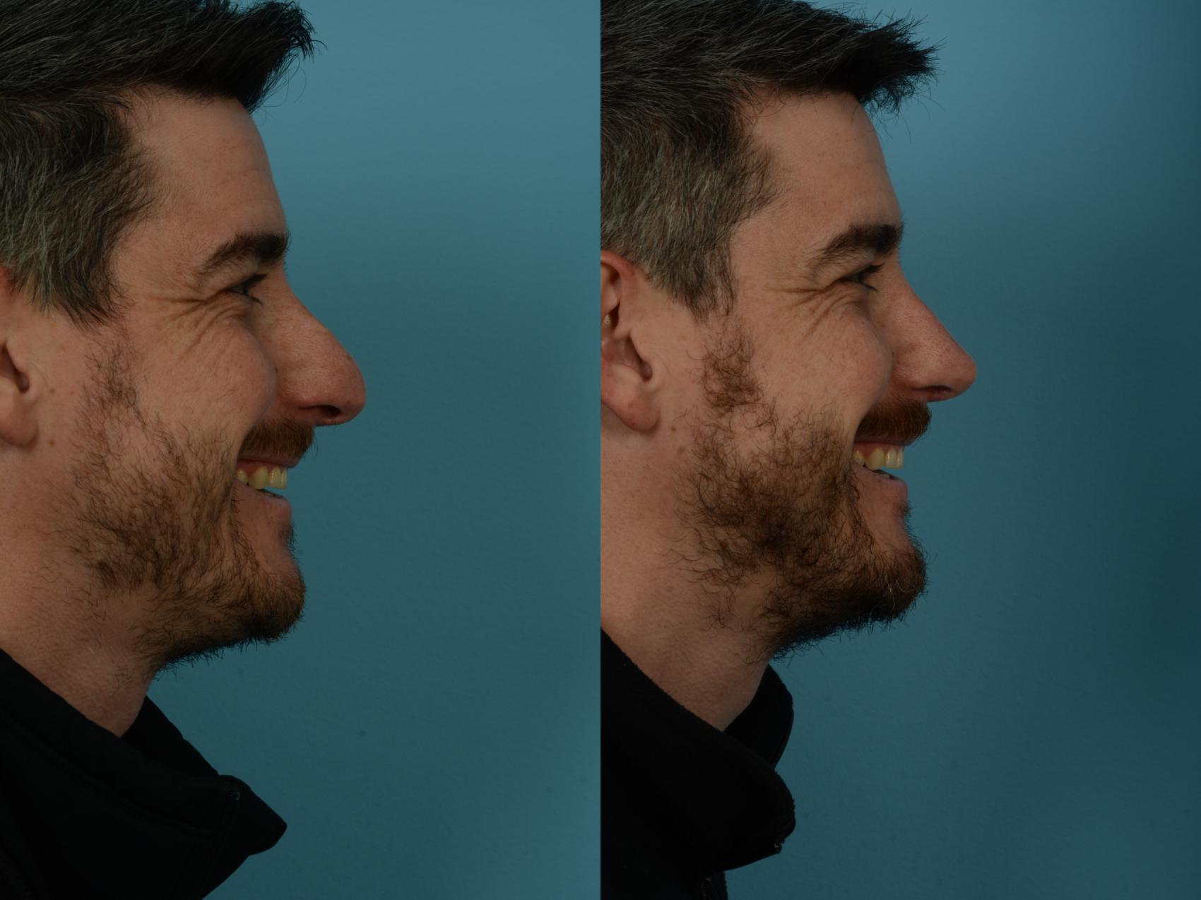 Before & After Rhinoplasty by Dr. Sinno Case 1133 Right Side View in Chicago, IL
