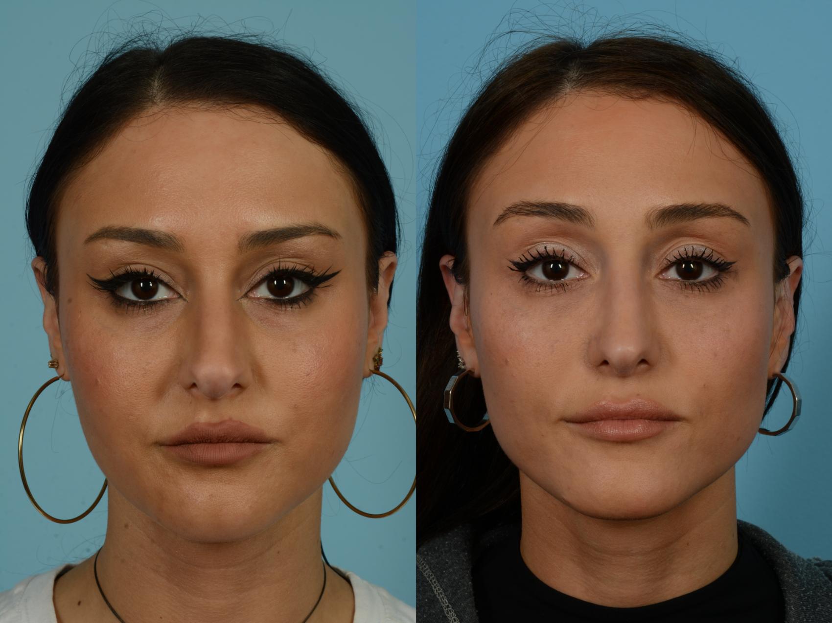 Before & After Rhinoplasty by Dr. Sinno Case 1135 Front View in Chicago, IL