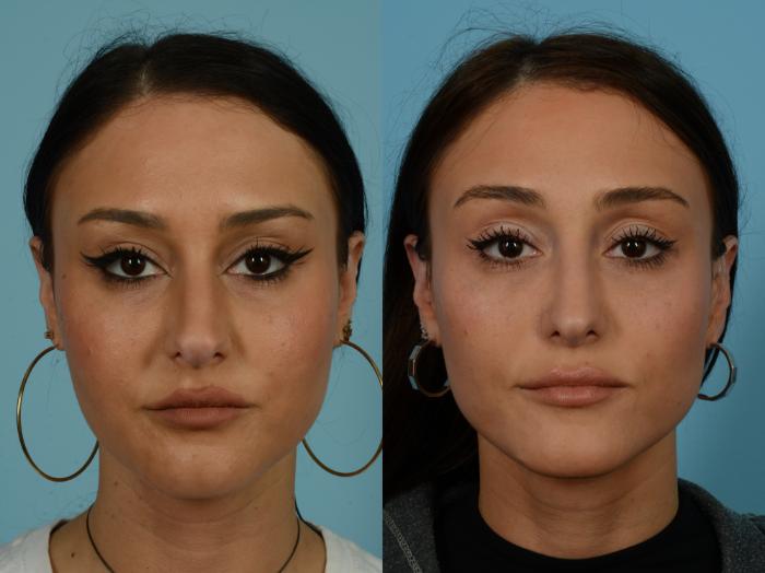 Before & After Rhinoplasty by Dr. Sinno Case 1135 Front View in Chicago, IL