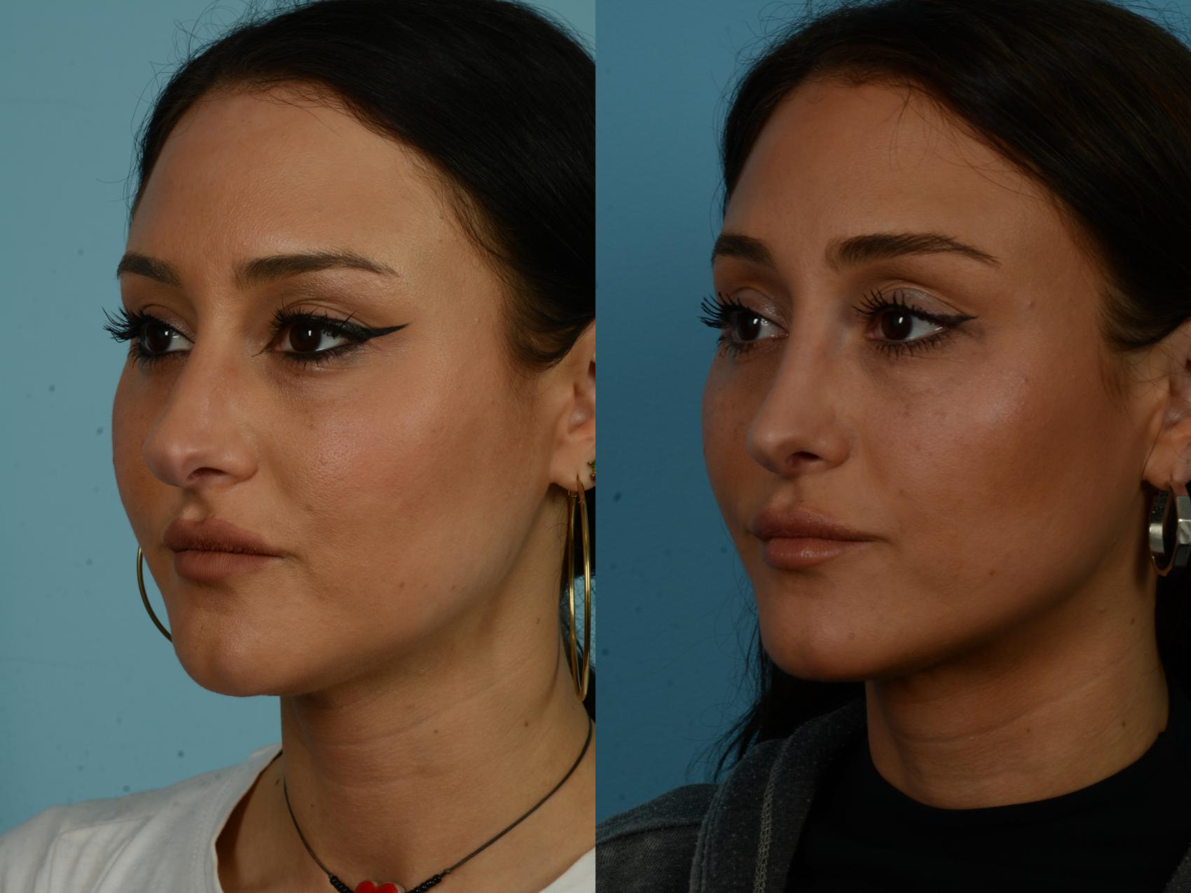 Before & After Rhinoplasty by Dr. Sinno Case 1135 Left Oblique View in Chicago, IL