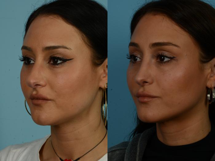 Before & After Rhinoplasty by Dr. Sinno Case 1135 Left Oblique View in Chicago, IL