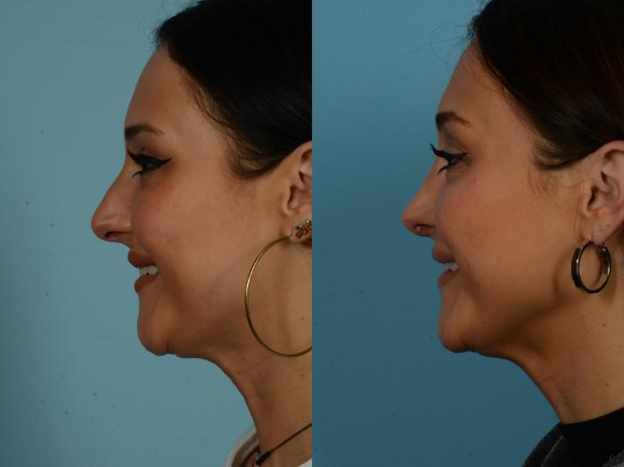 Before & After Rhinoplasty by Dr. Sinno Case 1135 Left Side View in Chicago, IL