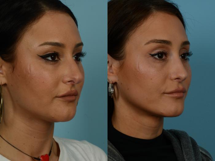 Before & After Rhinoplasty by Dr. Sinno Case 1135 Right Oblique View in Chicago, IL