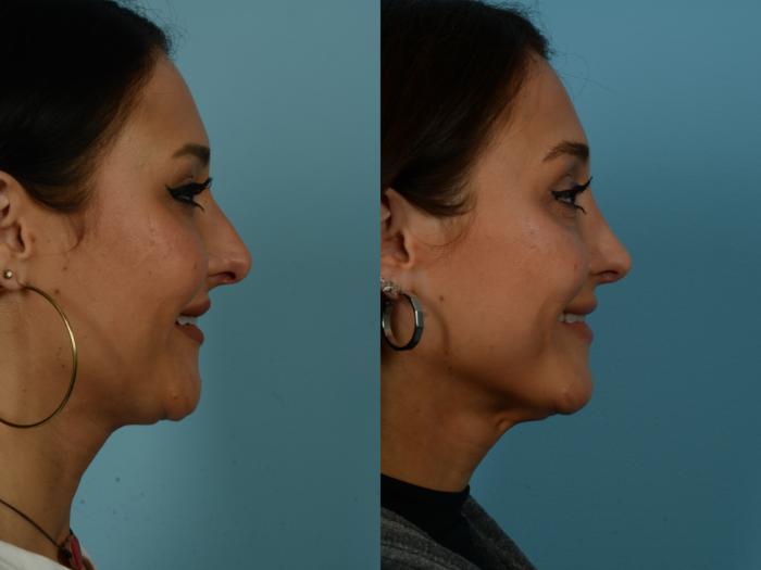 Before & After Rhinoplasty by Dr. Sinno Case 1135 Right Side View in Chicago, IL