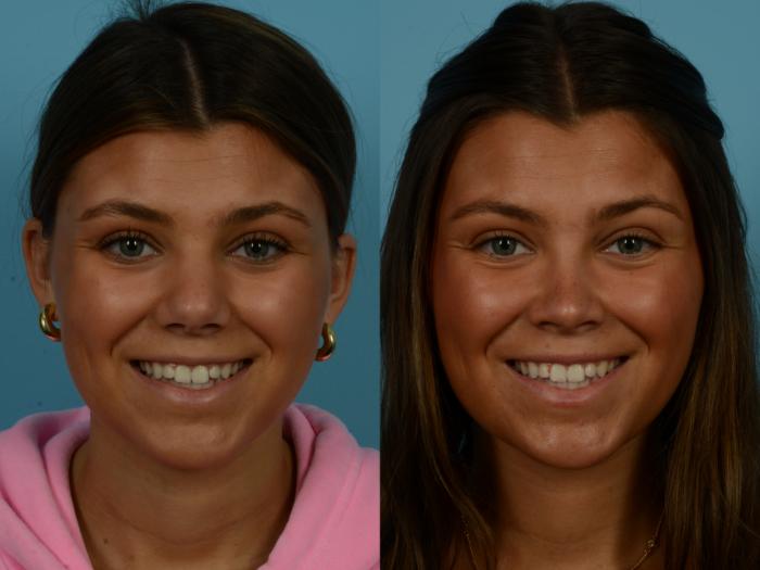 Before & After Rhinoplasty by Dr. Sinno Case 1140 Front View in Chicago, IL