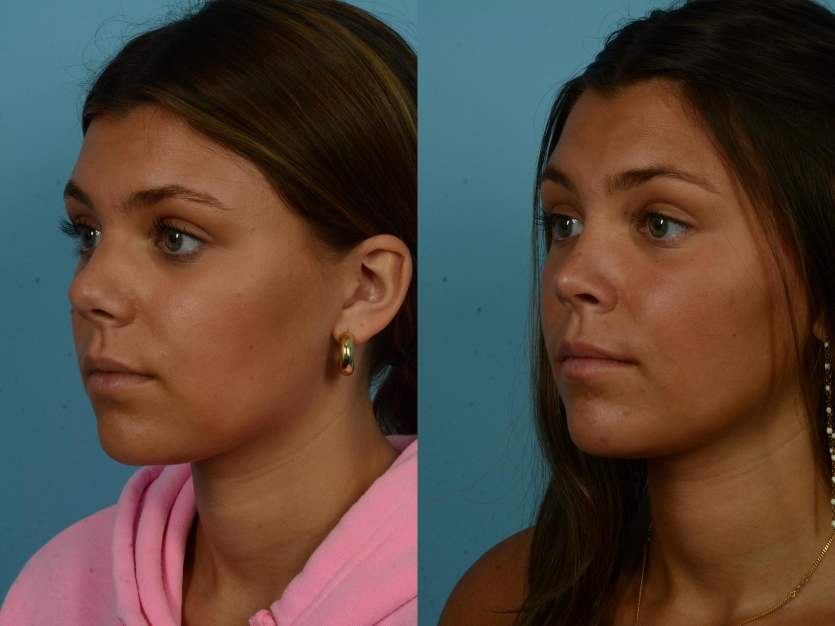 Before & After Rhinoplasty by Dr. Sinno Case 1140 Left Oblique View in Chicago, IL