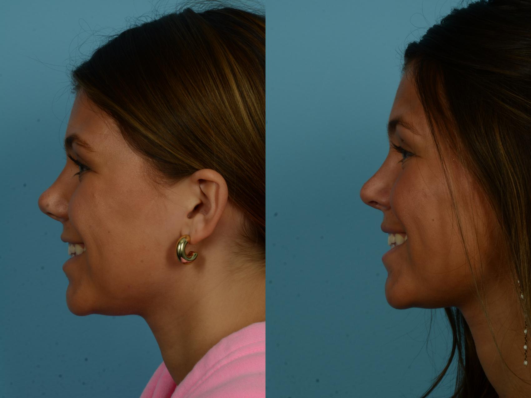Before & After Rhinoplasty by Dr. Sinno Case 1140 Left Side View in Chicago, IL