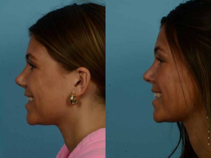 Before & After Rhinoplasty by Dr. Sinno Case 1140 Left Side View in Chicago, IL