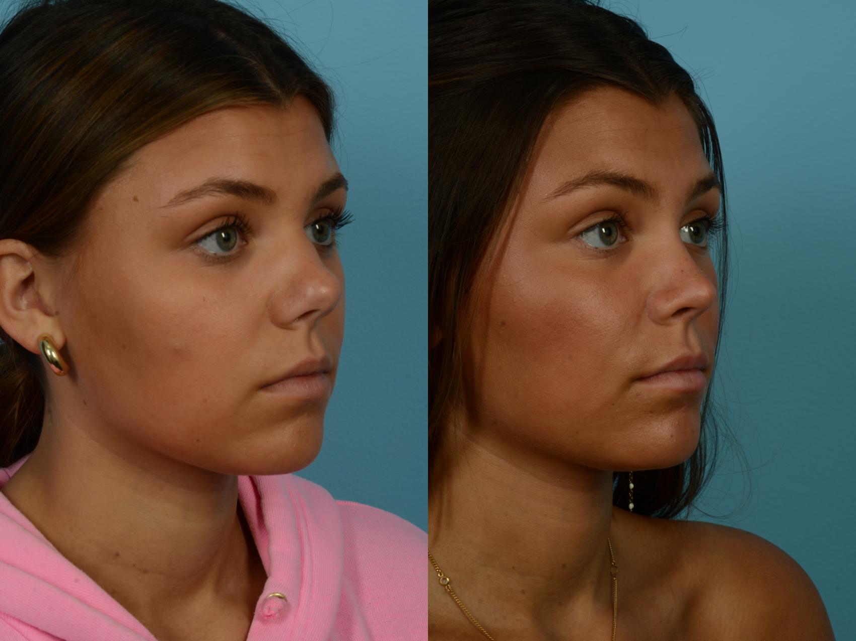 Before & After Rhinoplasty by Dr. Sinno Case 1140 Right Oblique View in Chicago, IL