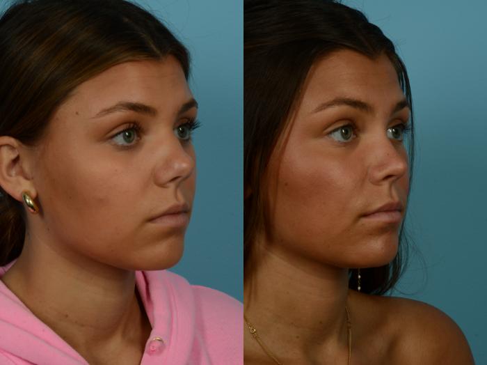 Before & After Rhinoplasty by Dr. Sinno Case 1140 Right Oblique View in Chicago, IL