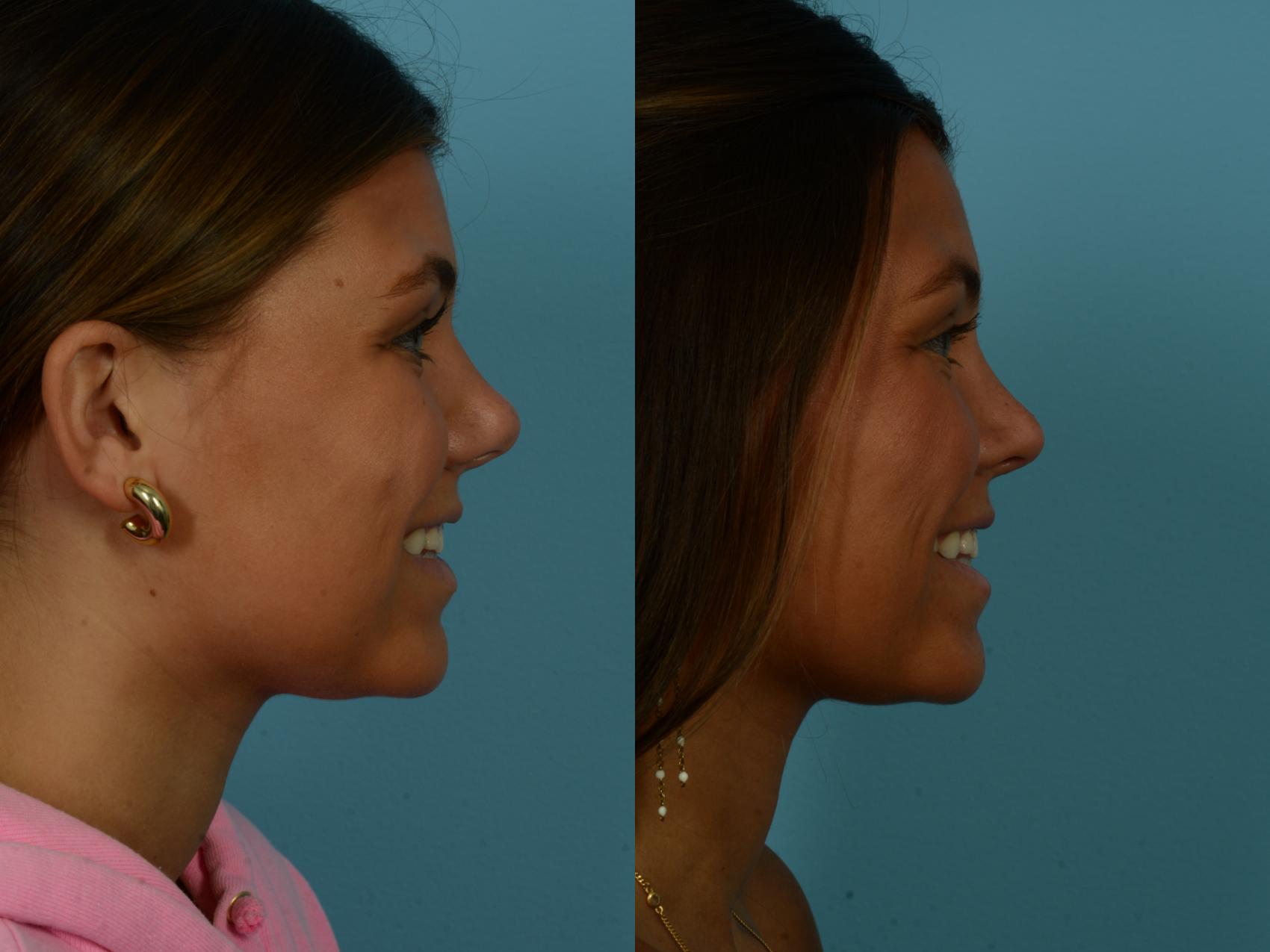 Before & After Rhinoplasty by Dr. Sinno Case 1140 Right Side View in Chicago, IL