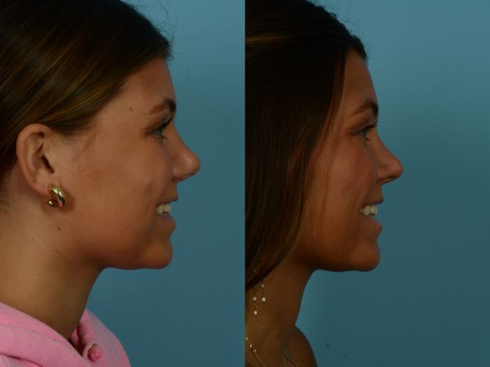 Before & After Rhinoplasty by Dr. Sinno Case 1140 Right Side View in Chicago, IL