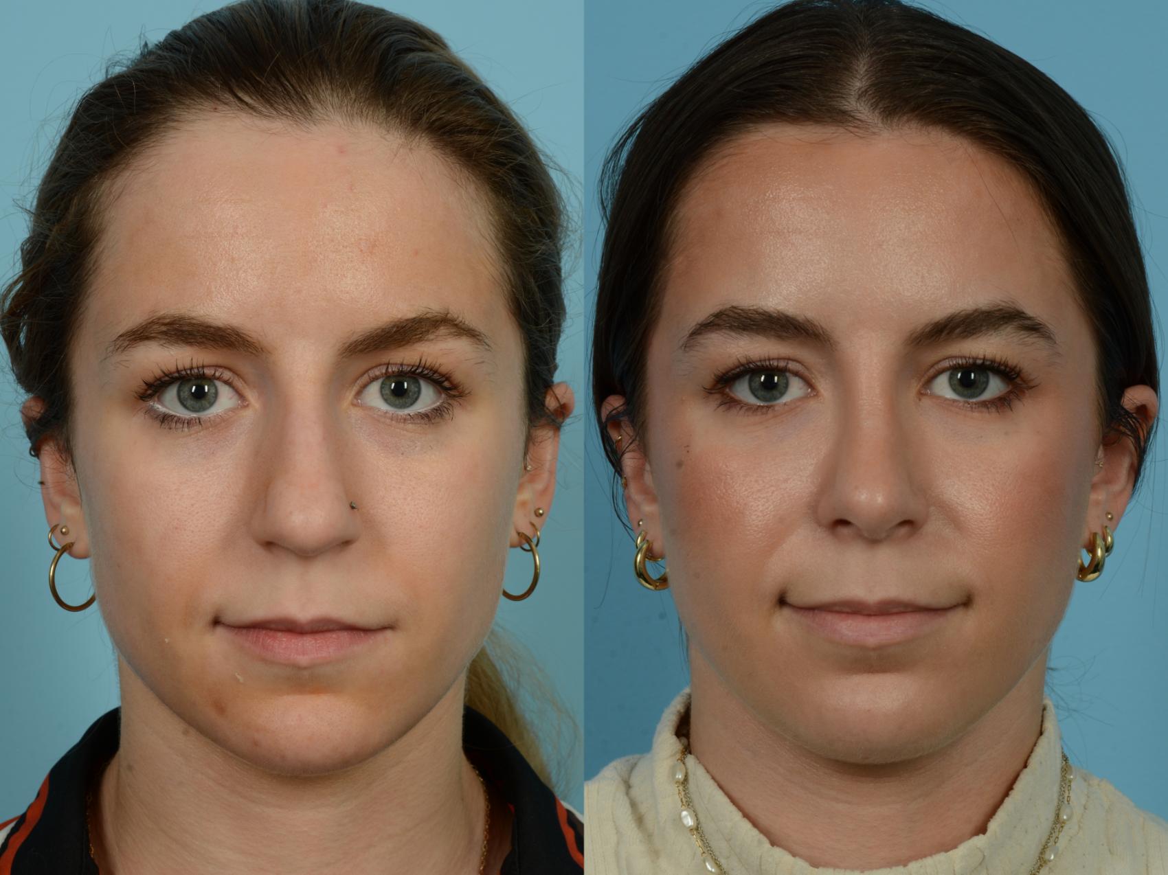 Before & After Rhinoplasty by Dr. Sinno Case 1143 Front View in Chicago, IL