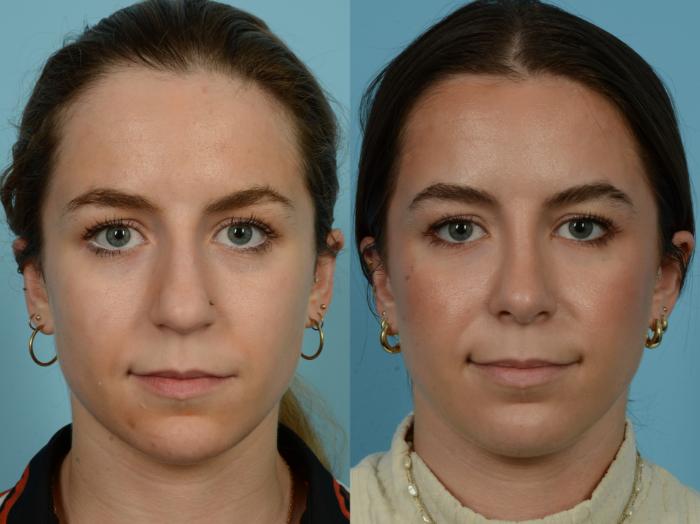 Before & After Rhinoplasty by Dr. Sinno Case 1143 Front View in Chicago, IL