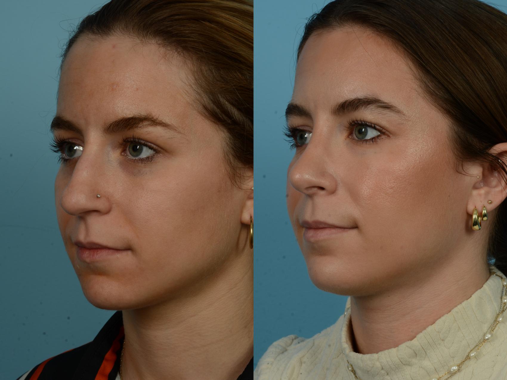 Before & After Rhinoplasty by Dr. Sinno Case 1143 Left Oblique View in Chicago, IL
