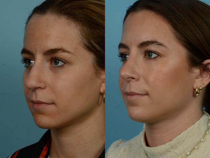 Before & After Rhinoplasty by Dr. Sinno Case 1143 Left Oblique View in Chicago, IL