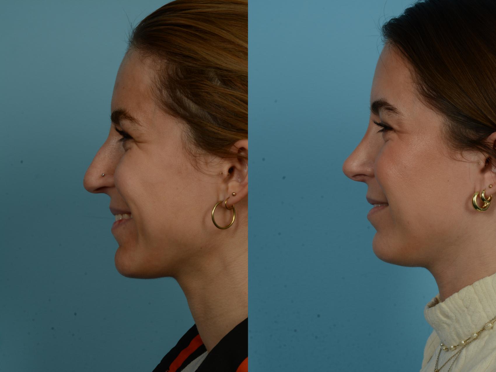 Before & After Rhinoplasty by Dr. Sinno Case 1143 Left Side View in Chicago, IL