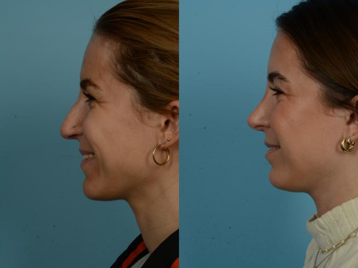 Before & After Rhinoplasty by Dr. Sinno Case 1143 Left Side View in Chicago, IL