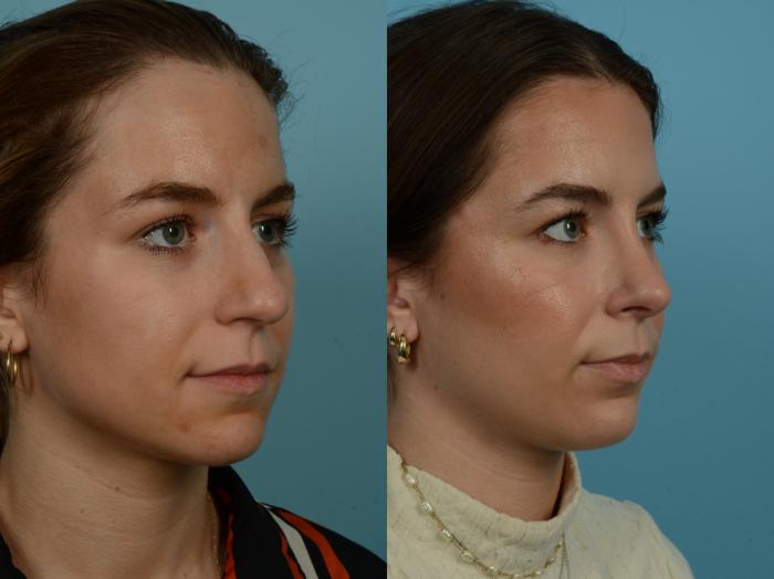 Before & After Rhinoplasty by Dr. Sinno Case 1143 Right Oblique View in Chicago, IL