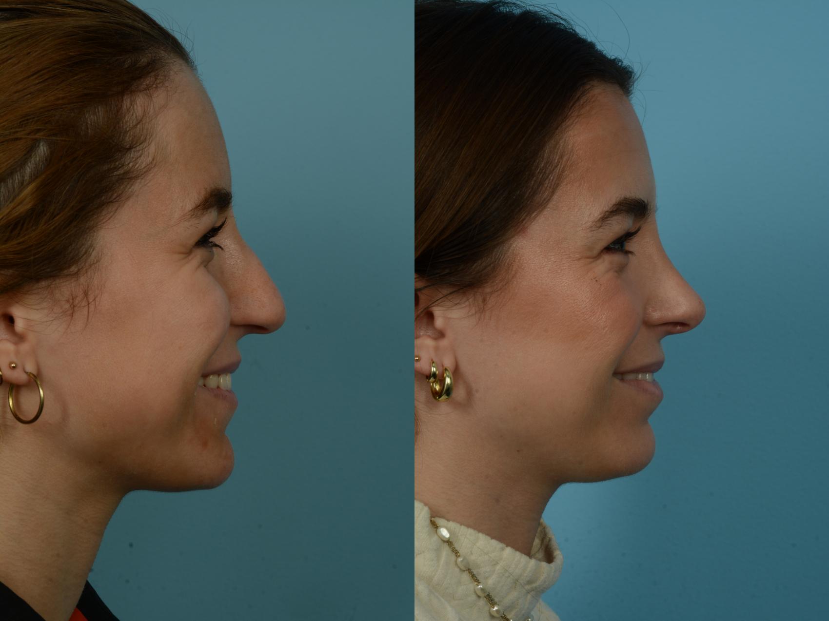 Before & After Rhinoplasty by Dr. Sinno Case 1143 Right Side View in Chicago, IL