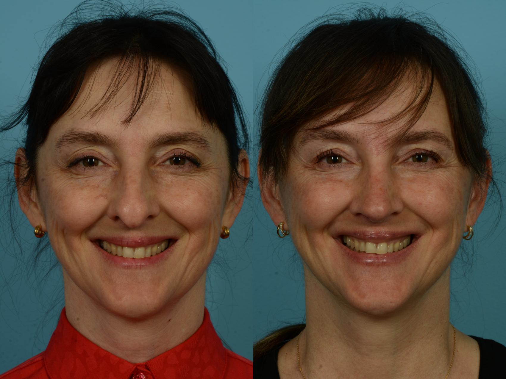 Before & After Rhinoplasty by Dr. Sinno Case 1144 Front View in Chicago, IL