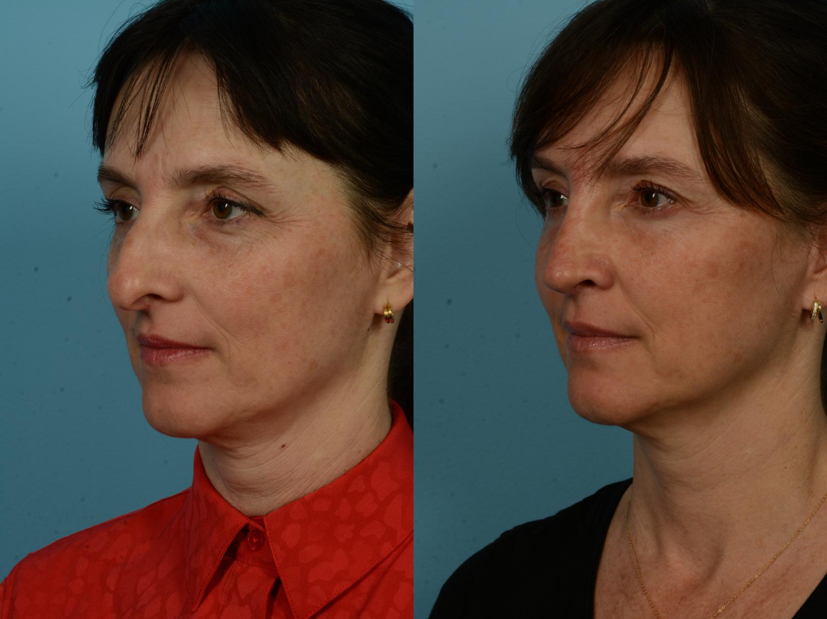 Before & After Rhinoplasty by Dr. Sinno Case 1144 Left Oblique View in Chicago, IL
