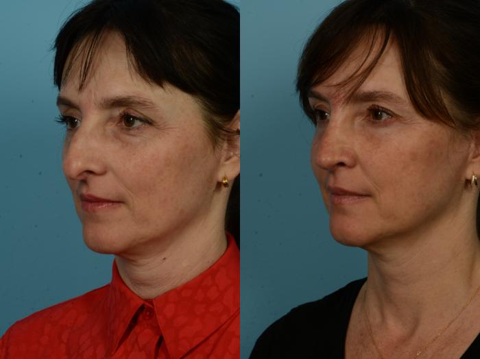 Before & After Rhinoplasty by Dr. Sinno Case 1144 Left Oblique View in Chicago, IL