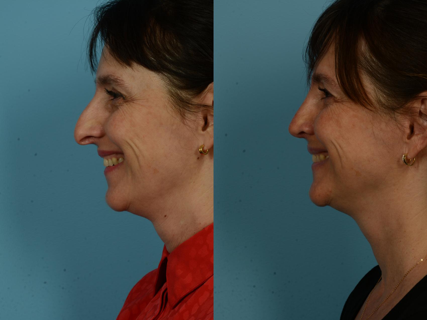 Before & After Rhinoplasty by Dr. Sinno Case 1144 Left Side View in Chicago, IL