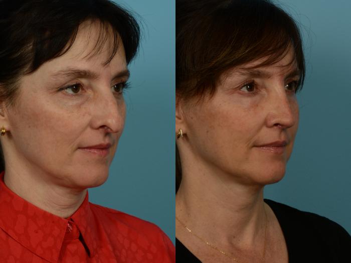 Before & After Rhinoplasty by Dr. Sinno Case 1144 Right Oblique View in Chicago, IL