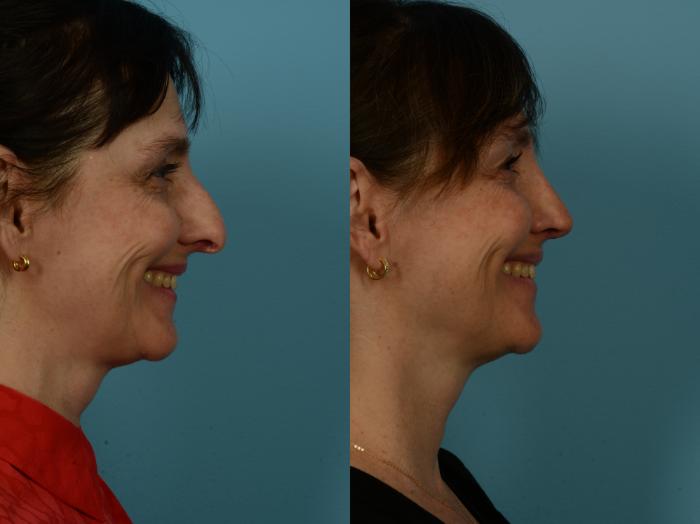 Before & After Rhinoplasty by Dr. Sinno Case 1144 Right Side View in Chicago, IL